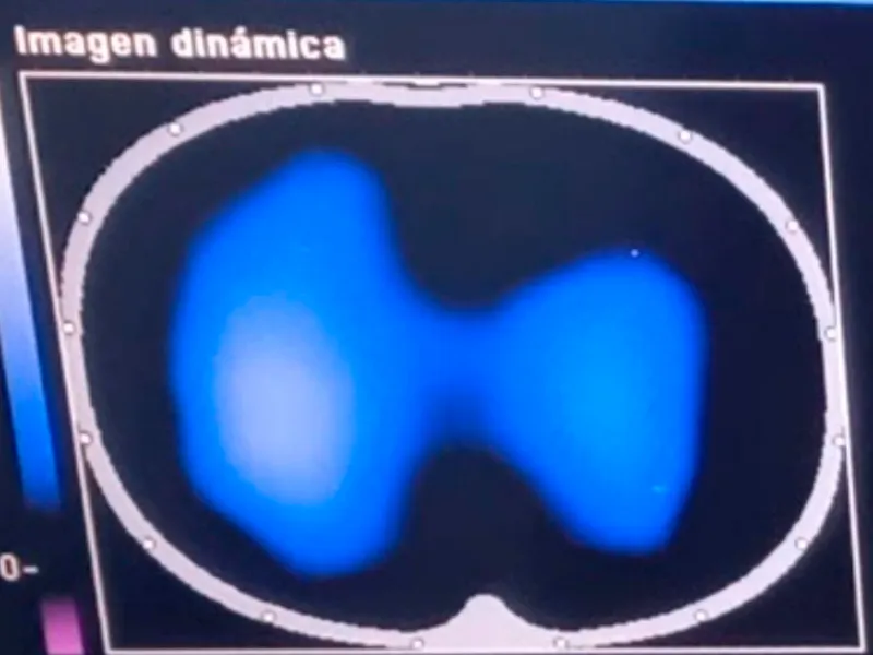 Imágenes de tomografía que se toman para analizar el desempeño de la fisioterapia con el inventivo Ubicu Imágenes de tomografía que se toman para analizar el desempeño de la fisioterapia con el inventivo Ubicu