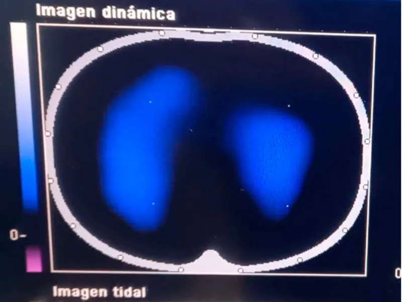 Imágenes de tomografía que se toman para analizar el desempeño de la fisioterapia con el inventivo Ubicu Imágenes de tomografía que se toman para analizar el desempeño de la fisioterapia con el inventivo Ubicu